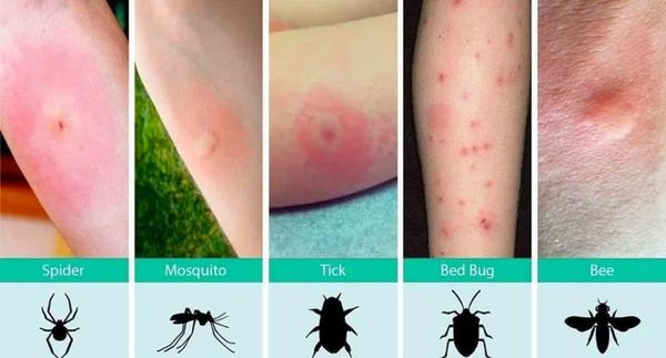 How To Recognize Various Bug Bites