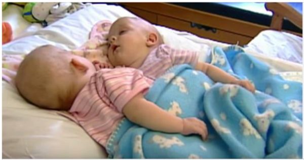 10 years ago these conjoined twins were separated through advanced surgery: Now they are all grown up