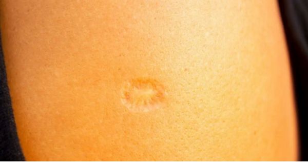 The Smallpox Scar: A Mark of History