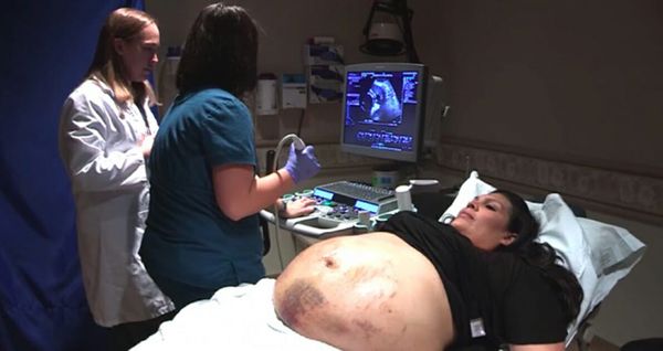 Mom has bruises all over her belly: Then doctor looks closer at ultrasound and freezes