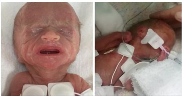 Baby Girl Born Weighing Just 1 Pound Leaves Hospital After 4 Months – See How She Looks Today