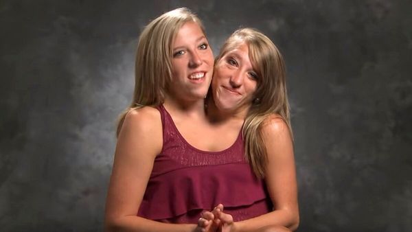 Abigail and Brittany Hensel: Extraordinary Conjoined Twins