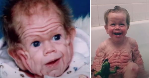 Tomm Tennent: The unique baby born with enough skin for a five-year-old child