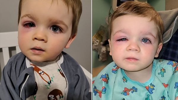 Mom issues warning after toddler nearly lost eyesight from bath toy