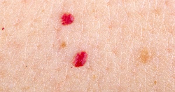 Understanding the Red Dots on Your Skin