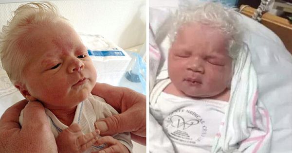 Baby Boy Born with a Startling Appearance Captivates Hearts