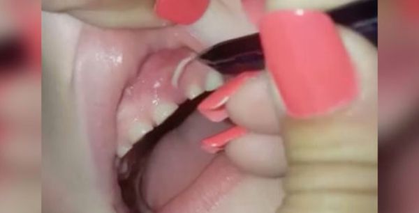 Her Son Complains About A Pain In His Gums. Mom Grabs The Tweezers And Makes A Surprising Discovery