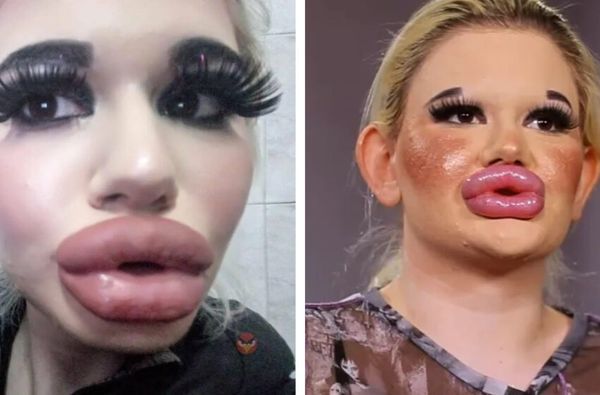 The Astonishing Transformation of Andrea: A Tale of Beauty and Plastic Surgeries