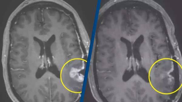 Remarkable Cancer Breakthrough: Woman’s Brain Tumor Nearly Disappears in Just Five Days