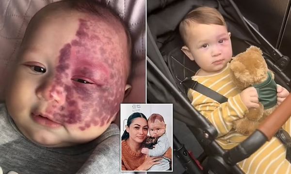 Mom Is Slammed Online After Removing Baby’s Birthmark With A Laser