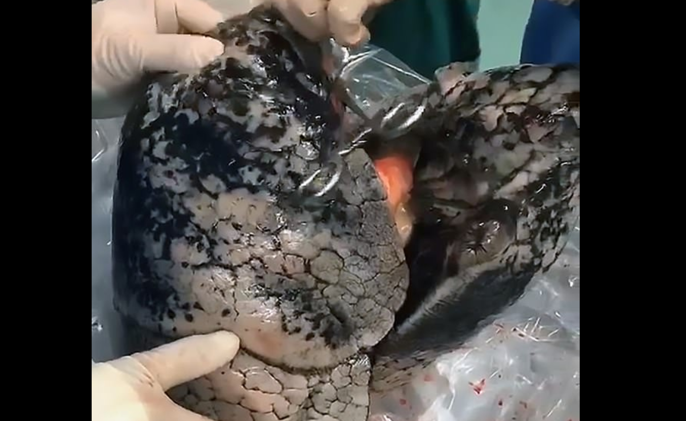 When Doctors Pulled This Out Of His Body, They Knew The Cause Of Death Immediately