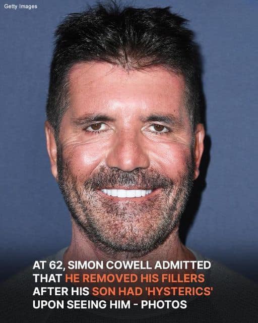 Simon Cowell Removed His Fillers after His Son Had ‘Hysterics’: Photos Without Fillers