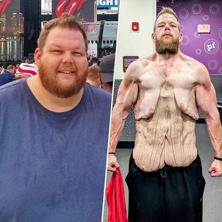 360 Pounds and Counting: Cole Prochaska’s Battle Isn’t Over Yet – The Fight Against Excess Skin