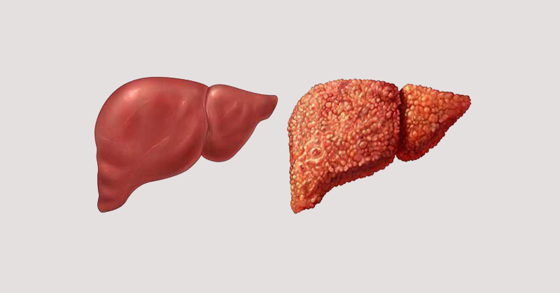 If You Have Itches in These 2 Body Parts, It Could Be a Sign of Liver Disease. Don’t Mistake It for an Allergy!