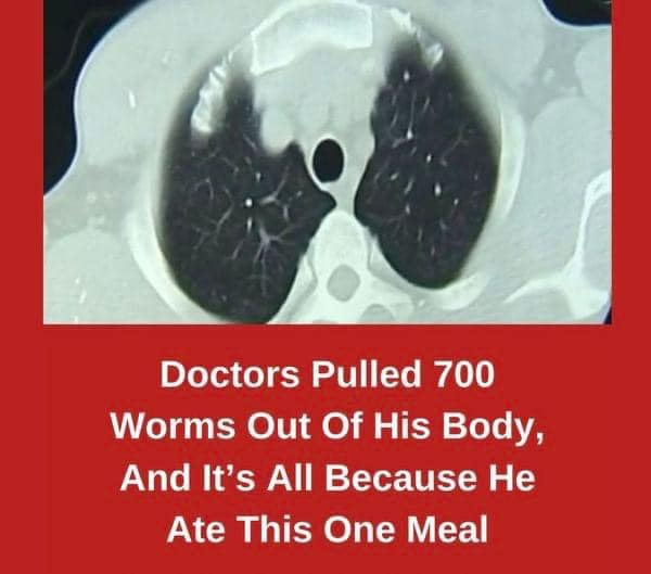 Shocking Discovery: Man’s Brain and Lungs Riddled with Worms After Uncooked Pork Meal!