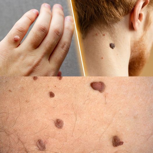 How to Remove Skin Tags and Warts Overnight: Safe and Effective Methods