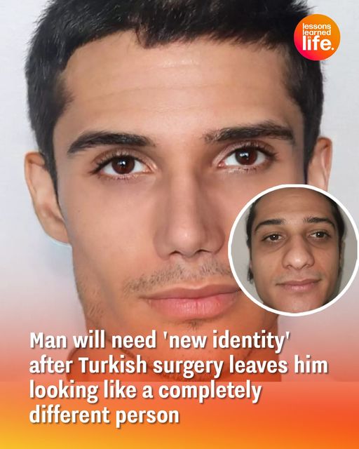 Man Will Need ‘New Identity’ After Turkish Surgery Leaves Him Looking Like a Completely Different Person