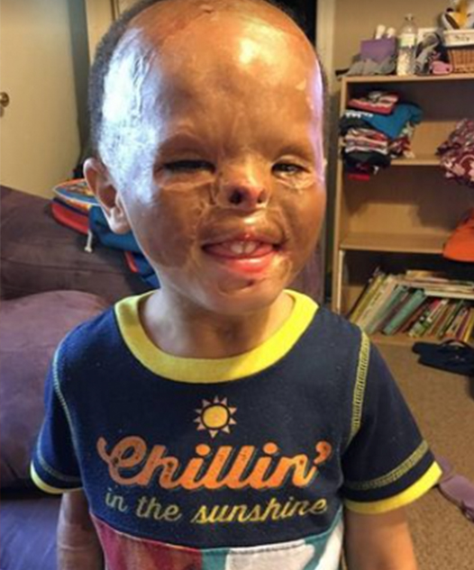 He was just a baby when a fire ripped through the apartment where he slept, leaving him with horrific burns all over his face.