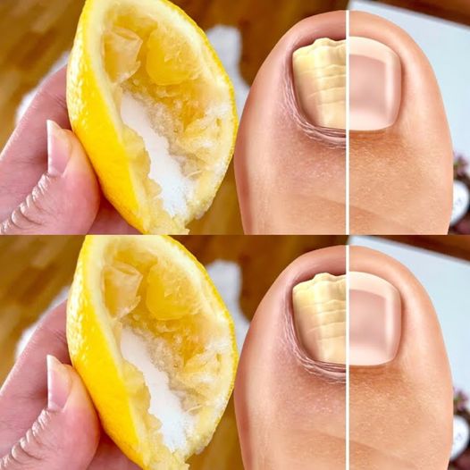 Nail Fungus Removal: 100% Natural Treatment for Toenail Fungus Using Lemon and Salt