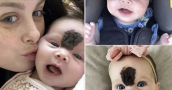 A Mom’s Journey to Remove Her Daughter’s Birthmark